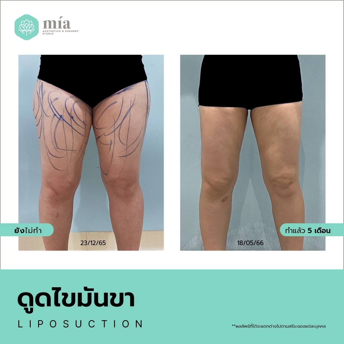 thigh liposuction  sculpting legs for a sleeker look