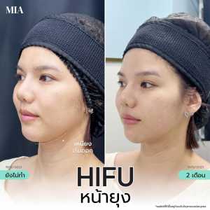 Hifu หน้ายุง 5