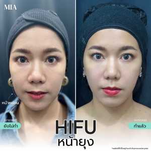 Hifu หน้ายุง 6