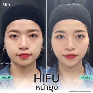 Hifu หน้ายุง 8