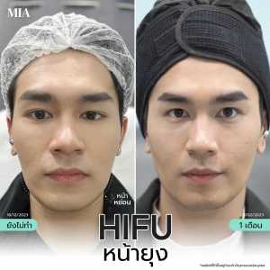 Hifu หน้ายุง 9