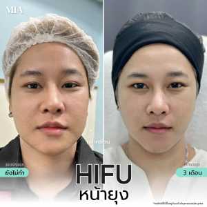 Hifu หน้ายุง 12