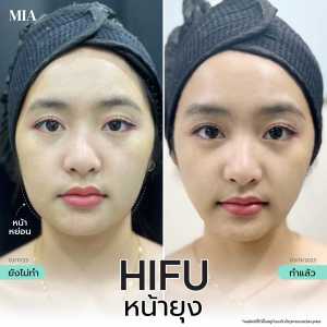 Hifu หน้ายุง 15