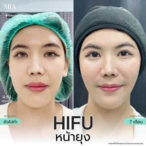 Hifu หน้ายุง 16