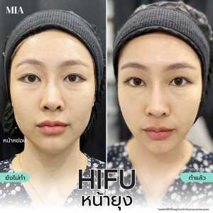 Hifu หน้ายุง 17