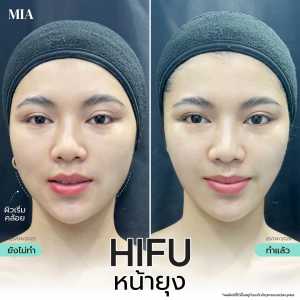 Hifu หน้ายุง 18