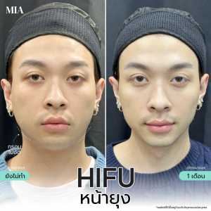 Hifu หน้ายุง 19