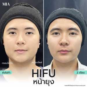 Hifu หน้ายุง 20