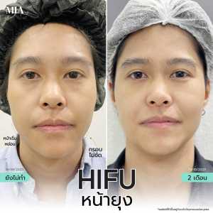 Hifu หน้ายุง 21