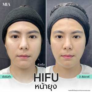 Hifu หน้ายุง 22