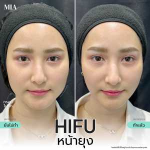 Hifu หน้ายุง 23