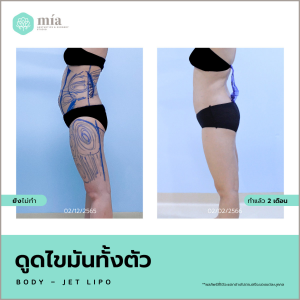 ดูดไขมัน Body-Jet 2