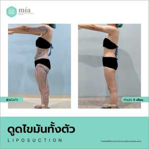 รีวิวดูดไขมันทั้งตัวผู้หญิง 9