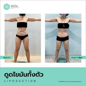 รีวิวดูดไขมันทั้งตัวผู้หญิง 6