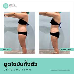 รีวิวดูดไขมันทั้งตัวผู้หญิง 10