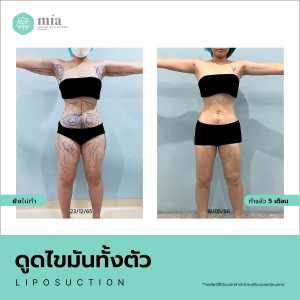 รีวิวดูดไขมันทั้งตัวผู้หญิง 7