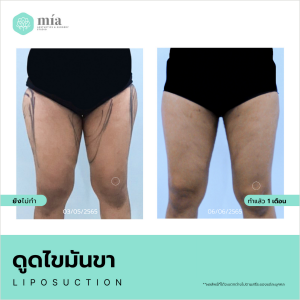 รีวิวดูดไขมันขาผู้หญิง 7